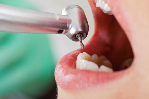 Best Dentist for Tooth Abscess  in University Park, MD